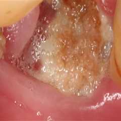 What Are the Chances of Infection After Tooth Extraction?