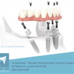 All on 4 Dental Implants NW1