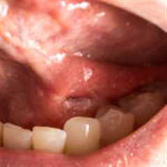 Mouth Cancer: Causes, Effects and treatments.