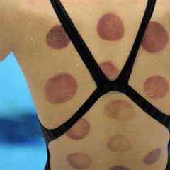 5 Reasons To Try Cupping Therapy