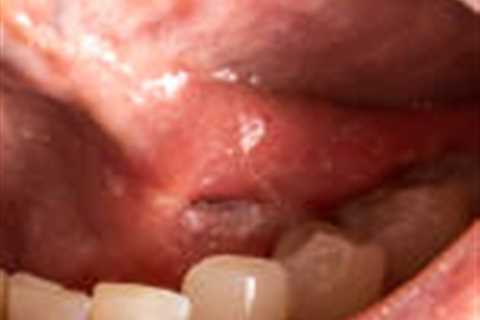 Mouth Cancer: Causes, Effects and treatments.