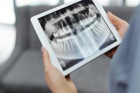 Your Veneers Start With Precision: Why Dental X-Rays Matter In Honolulu