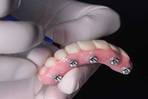 All-on-4 Dental Implants | Edental Perth