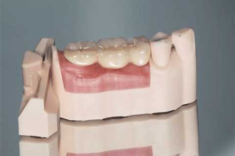 Fixed Implant Bridge | Edental Perth
