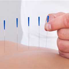 Advantages Of Hiring An Acupuncturist Skilled In Natural Remedies In Okotoks, AB