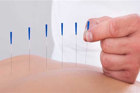 Advantages Of Hiring An Acupuncturist Skilled In Natural Remedies In Okotoks, AB