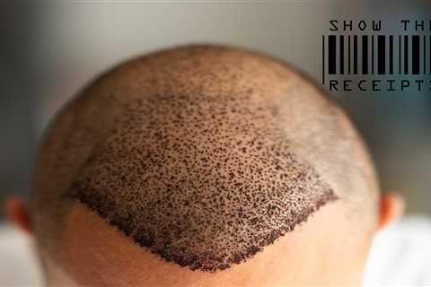 American Resilience: Man's Investment in Confidence Through Hair Transplant