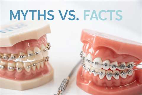 Metal Orthodontic Braces: Myths vs. Facts
