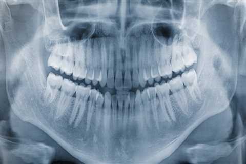 How Dental X-Rays Help Detect Problems Before They Become Serious