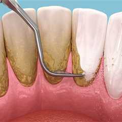 Effective Strategies to Prevent Plaque Buildup Between Teeth Cleanings