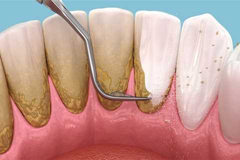 Effective Strategies to Prevent Plaque Buildup Between Teeth Cleanings